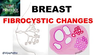 Diseases of Breast Part 1 Normal anatomy Classification amp FIBROCYSTIC CHANGES [upl. by Einor]