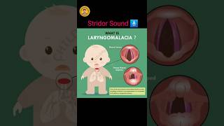 Laryngomalacia sound 🩺⚕ viral doctor shortvideo aiims human [upl. by Paulsen]