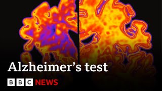 Blood test may revolutionise treatment of Alzheimers disease  BBC News [upl. by Ardis504]