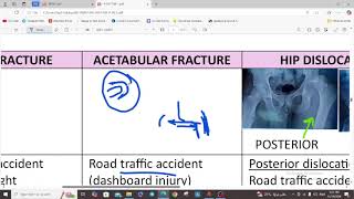 LOWER LIMB FRACTURES  ORTHOPEDICS  5TH YEAR [upl. by Liz]