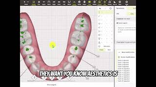 Correcting Crowding Attrition Occlusion Black Triangles with Invisalign Clincheck [upl. by Roots]