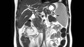 Primary Sclerosing Cholangitis PSC [upl. by Cigam29]