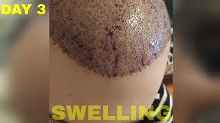 Hair Transplant Results DAY 3 FUE Turkey [upl. by Par]