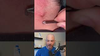 Derm reacts to infected ingrown hair dermreacts doctorreacts ingrownhair [upl. by Nels]