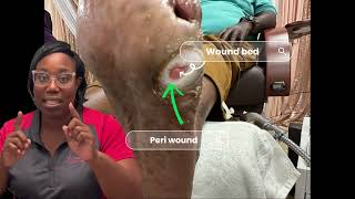 Diabetic Foot Ulcer Debridement Wound bed amp Peri wound explained👣🗣️‼️ [upl. by Thagard351]