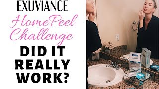 Do At Home Peels REALLY Work My Exuviance Peel Results [upl. by Llenwad]