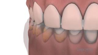 Gingivoplasty and gingivectomy  Lapointe dental centres [upl. by Asiek660]