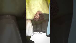 Bone Grafting Explained How It Works and When It’s Needed facts shorts [upl. by Hanson]