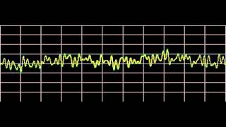 Sinusitis  Rife Frequencies [upl. by Ennylyak710]