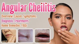 Angular cheilitis overview causes sign and symptoms diagnosis treatment home remedies and FAQs [upl. by Richlad]