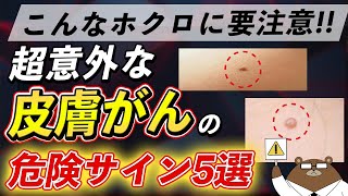 体にこんな「ほくろ」があったら絶対に見逃さないで！皮膚がんの危険な5つのサインとは？ [upl. by Russon]