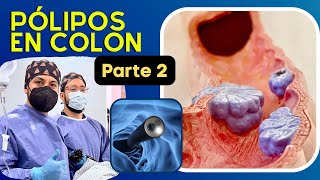 Síntomas Diagnostico y Tratamiento de los Pólipos en Colon  Parte 2  Dr Juan Pablo Hernández [upl. by Hgierb167]