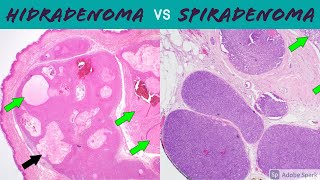 Hidradenoma Acrospiroma vs SpiradenomaCylindroma 5Minute Pathology Pearls [upl. by Orville]