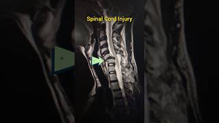 Spinal Cord Injury [upl. by Hyrup]