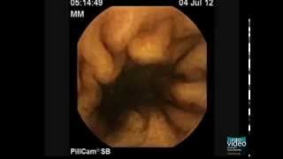 The PillCam Detection of Meckels Diverticulum [upl. by Ellierim]