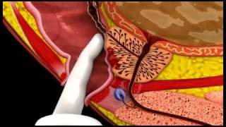 Prostate Cancer  3D Medical Animation  ABP © [upl. by Jutta]