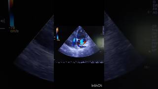 echocardiography echocardiography video echo caseGlobal hypokinesia echo [upl. by Artamas]