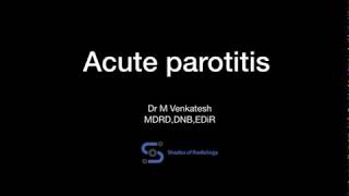 Acute parotitisUSG features [upl. by Eidolem]