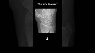 Hamate fracture  Oblique scaphoid view 91 Trauma Xray Upper limb Wrist radiologychannel007 [upl. by Rowe]