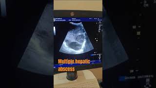 Multiple abscess in both lobe of Liver ultrasound usg abscess trendingyt [upl. by Ugo]