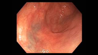 Colonoscopy Melanosis masquerading as cancer [upl. by Ettenyar]