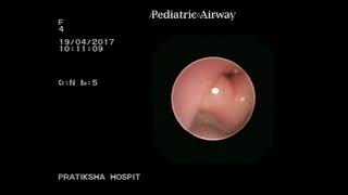 Congenital Laryngeal web Grade III [upl. by Oretos]