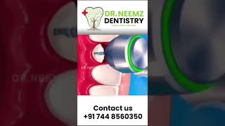 The Journey of a Dental Implant StepbyStep Animation [upl. by Nyvek]