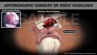 Arthroscopic Surgery of Right Shoulder [upl. by Woodrow]