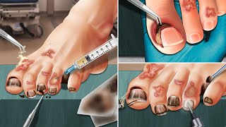 ASMR Remove ingrown toenails cut toenails and beautify toenails [upl. by Arbe]