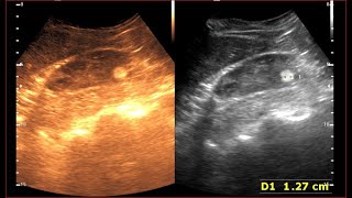 Angiomyolipoma kidney  Benign Renal Masses  Kidney Tumor [upl. by Pierpont851]