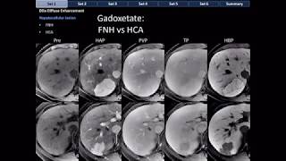 CT Differential Diagnosis of Focal Hepatic Lesions Basic Radiology [upl. by Naesyar370]