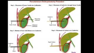 cholecystostomy percutaneous Gall bladder catheter drainage  percutaneous cholecystostomy [upl. by Moor]