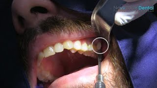 ¿Dientes de más en la boca Conoce los dientes SUPERNUMERARIOS 🦷🦷🦷 ¿Hay Muchos Dientes en la boca [upl. by Savitt]