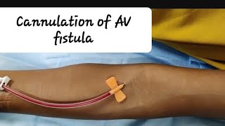 How to prick AV fistula First time Cannulation of AV fistula and Assessment [upl. by Niwrud]