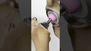 Total hip replacement explained 3D Animation [upl. by Haduhey606]