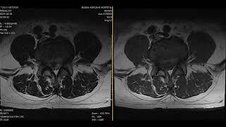 L45 Disc extrusion with mild inferior migration [upl. by Lucine]