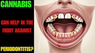 Cannabis vs Periodontitis A New Hope [upl. by Primaveria]