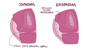 Hypospadias amp epispadias causes symptoms diagnosis treatment pathology [upl. by Arteid]