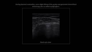 Long head of biceps brachii tendon anisotropy on shoulder ultrasound [upl. by Yralih]