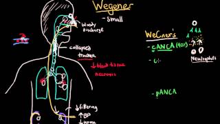 Wegener and Microscopic Polyangiitis [upl. by Cormier]