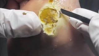 Pedicure video24，vertical plantaris，plantar wart [upl. by Johannah]