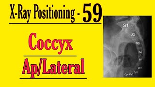 Coccyx APLateral Projection Hindi  X Ray Positioning for Radiographers  Doctor Inside Academy [upl. by Trimble153]