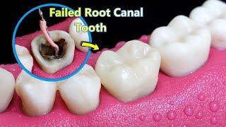 INCREDIBLE Reconstruction Of PoorFailed Root Canal Treated Tooth [upl. by Warrin450]