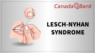 Lesch Nyhan Syndrome [upl. by Osric296]