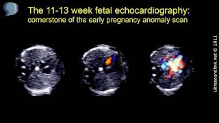 Fetal echocardiography at 1113 weeks of pregnancy [upl. by Isyad234]