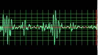 Infective Endocarditis Mitral Regurgitation slow [upl. by Karie]