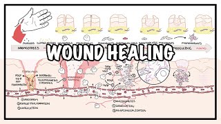 Wound Healing  Stages of healing and pathology [upl. by Goddart]