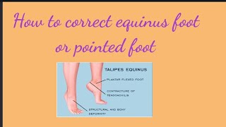 How to correct Equinus foot or pointed foot  Pinoy Physical Therapy [upl. by Animsay]