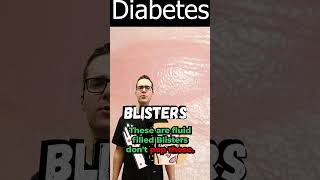 Blister on Foot Toe or Between Toes Diabetic Skin Symptoms [upl. by Ahsieyt]