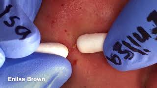 Blackheads Extractions on Christian Part 2 b [upl. by Groscr]